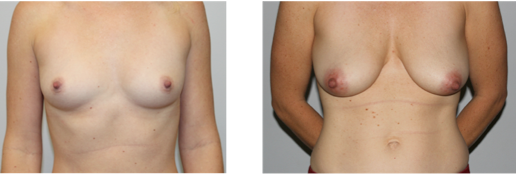 Before and after breast enhancement on a Knoxville Plastic Surgery patient