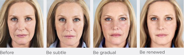 Sculptra before and after photo