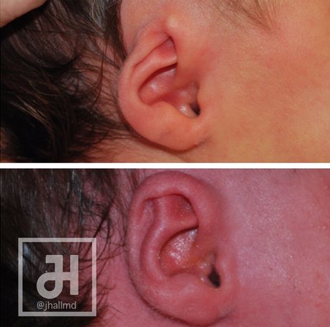 Before and after photos of ear reconstruction