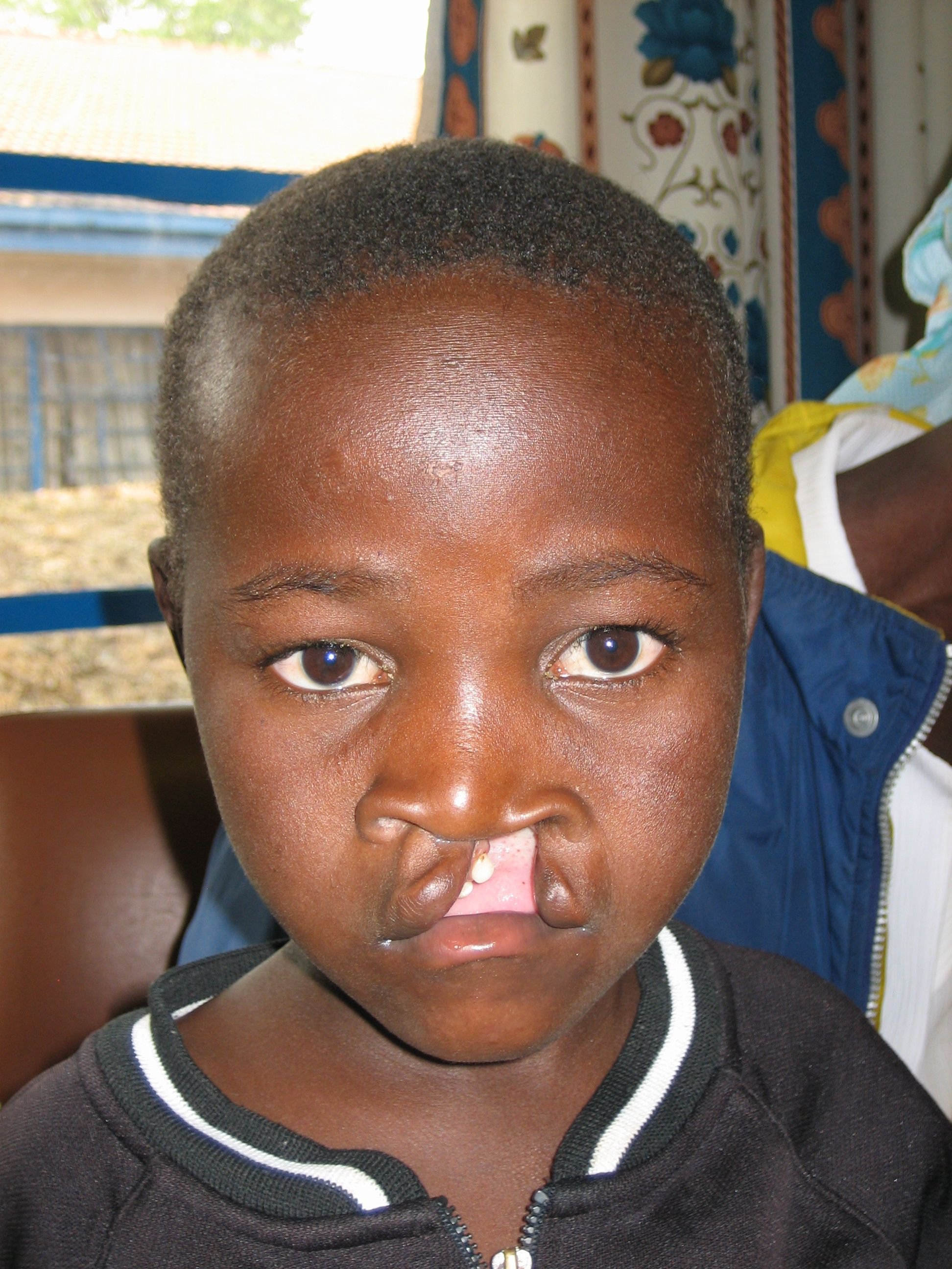 Zimbabwe child with cleft lip