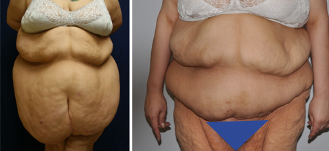 Insurance and Plastic Surgery after Massive Weight Loss