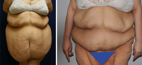 Tummy Tuck after Weight Loss in Brooklyn, NY. Cost, insurance coverage,  benefits, and the importance of choosing a skilled surgeon