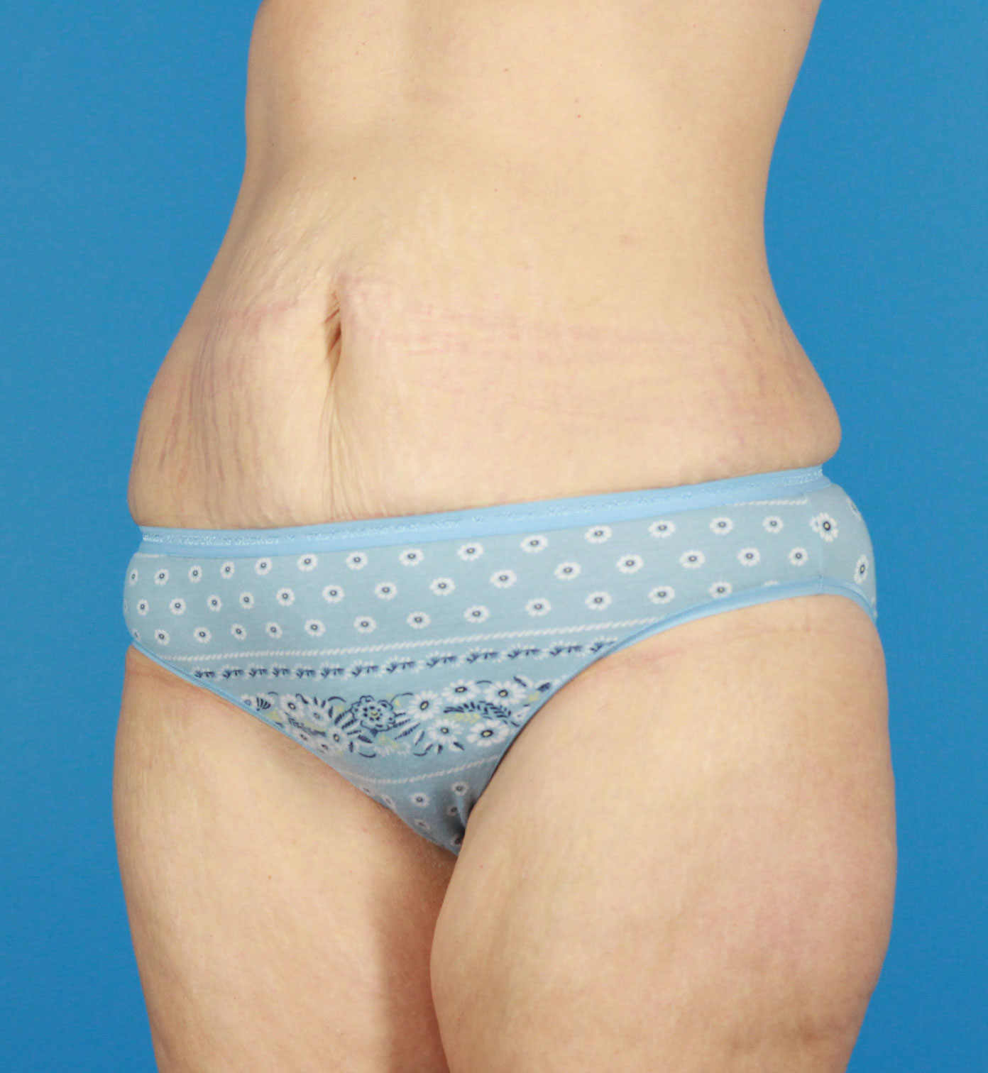 Arm-Lift and Thigh-Lift Before & After Image