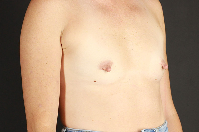 Breast Augmentation Before & After Image