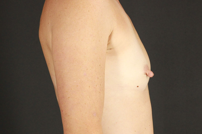 Breast Augmentation Before & After Image