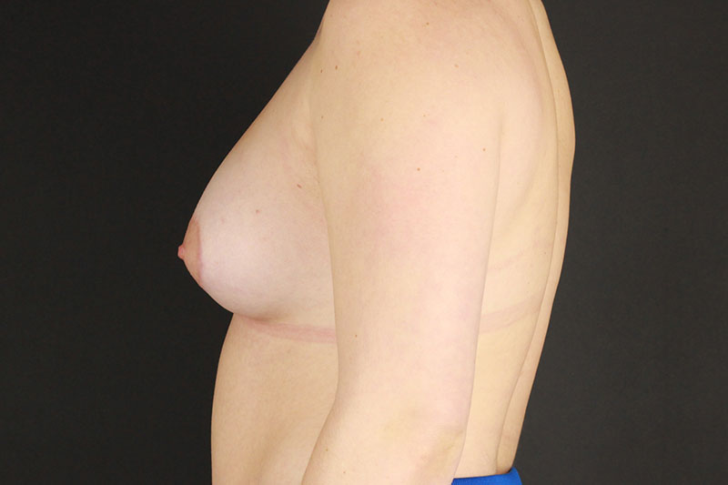 Breast Augmentation Before & After Image