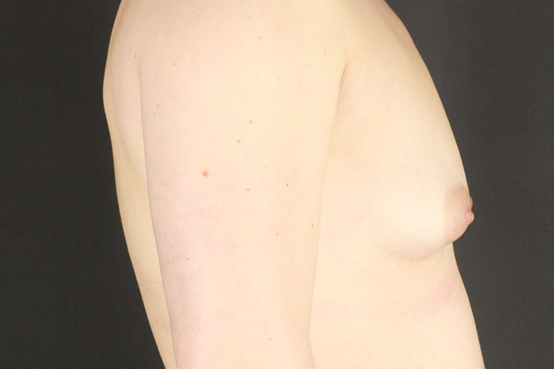 Breast Augmentation Before & After Image