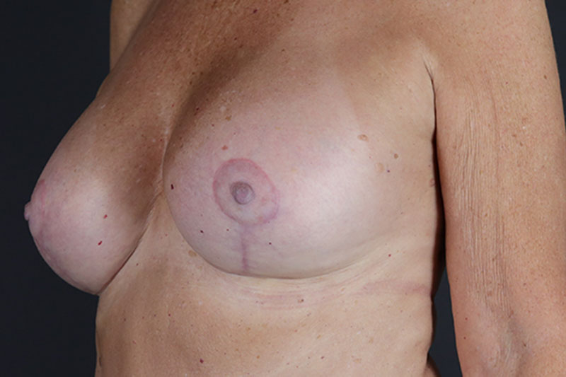 Breast Lift with Augmentation Before & After Image