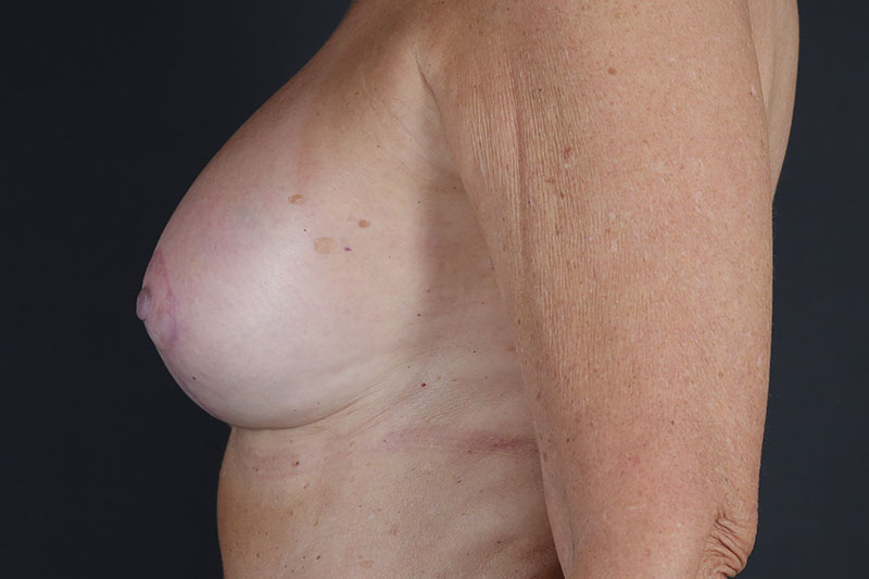 Breast Lift with Augmentation Before & After Image
