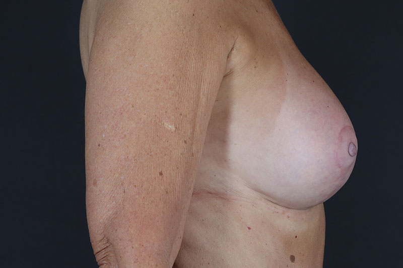 Breast Lift with Augmentation Before & After Image