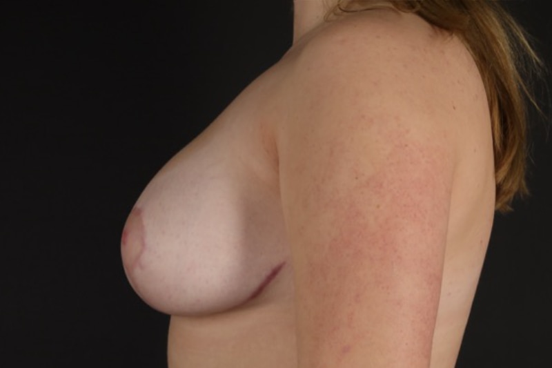 Breast Reduction Before & After Image