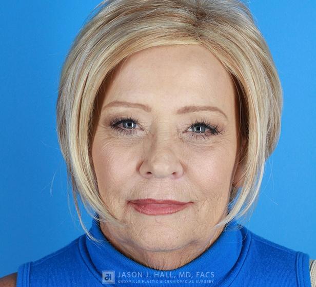 Blepharoplasty and Brow Lift Before & After Image