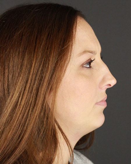 Chin and Neck Liposuction Before & After Image