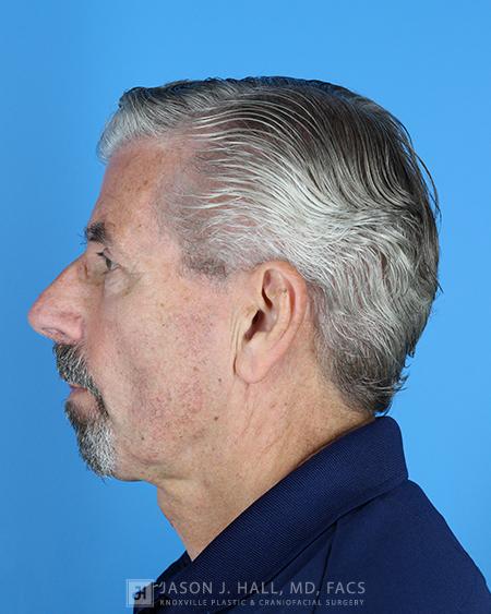 Chin and Neck Liposuction Before & After Image