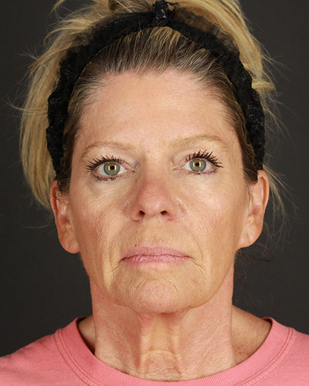 Facelift Before & After Image