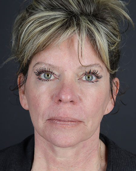Facelift Before & After Image