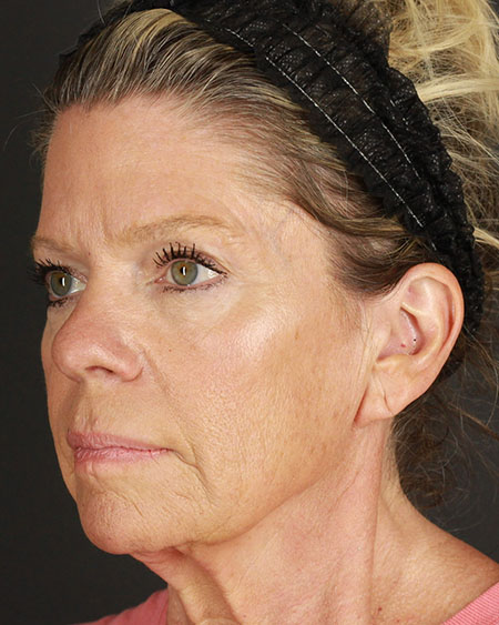 Facelift Before & After Image