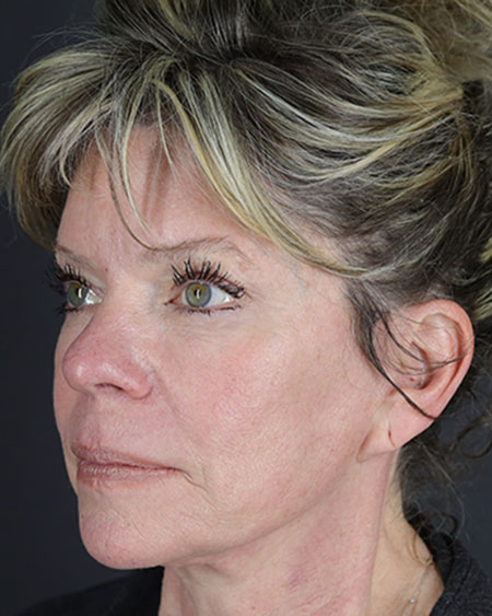 Facelift Before & After Image