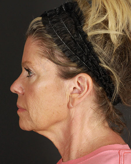 Facelift Before & After Image