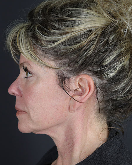 Facelift Before & After Image