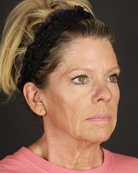 Facelift Before & After Image
