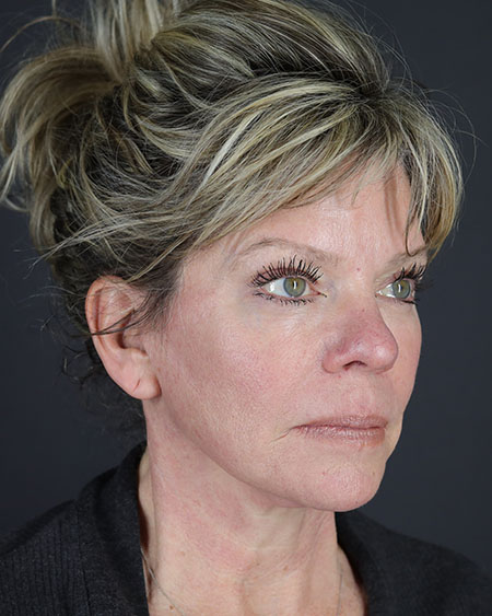 Facelift Before & After Image