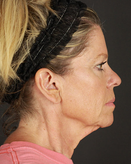 Facelift Before & After Image