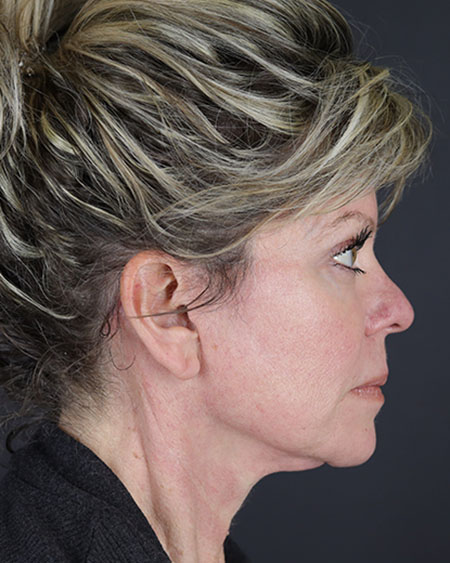 Facelift Before & After Image