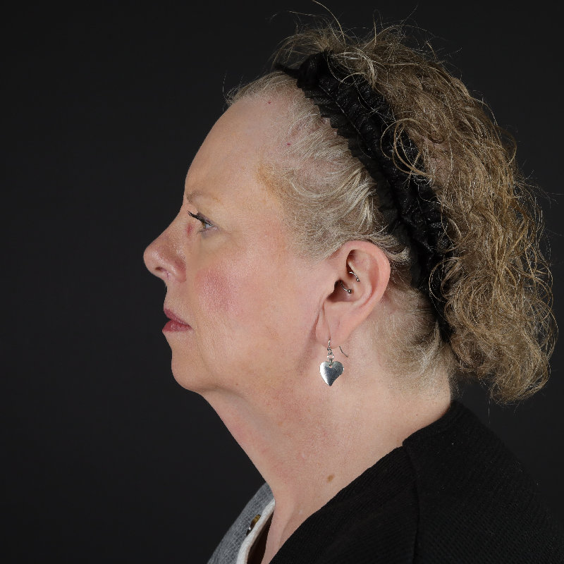 Facelift Before & After Image