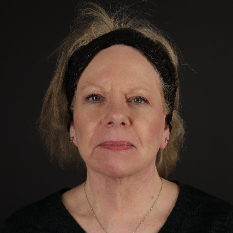 Facelift Before & After Image