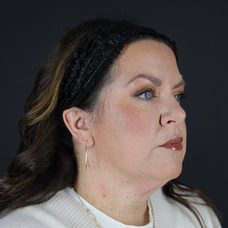 Facelift Before & After Image