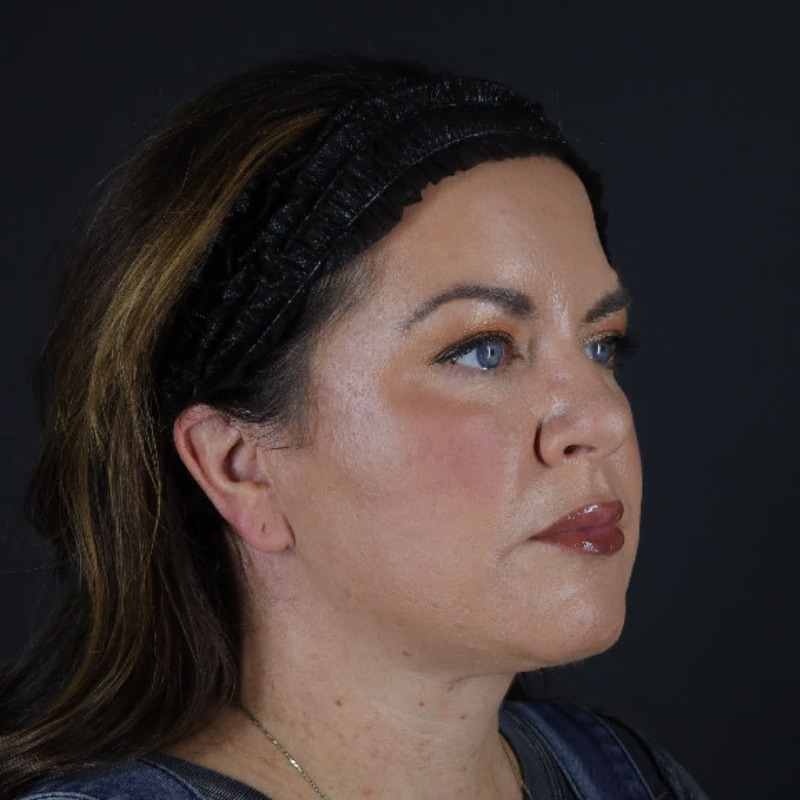 Facelift Before & After Image