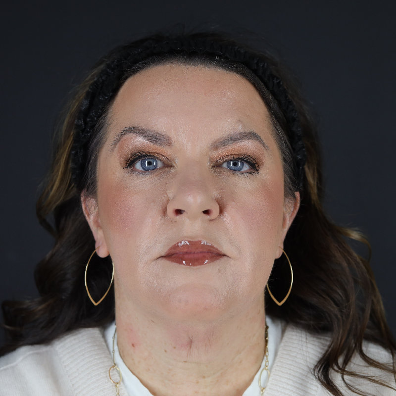 Facelift Before & After Image