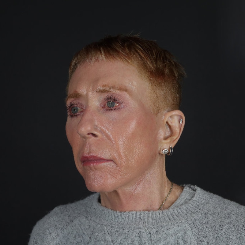 Facelift Before & After Image