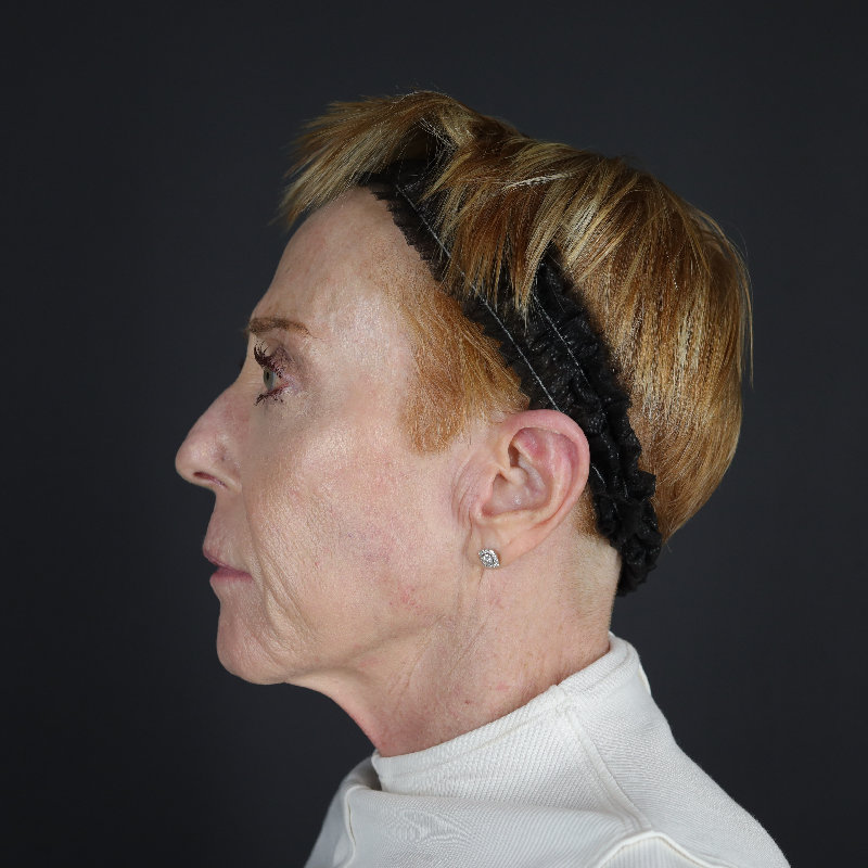 Facelift Before & After Image