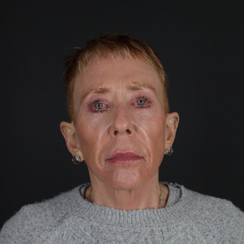 Facelift Before & After Image
