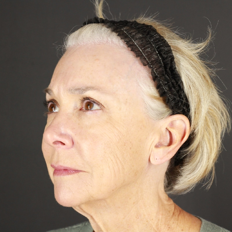 Facelift Before & After Image