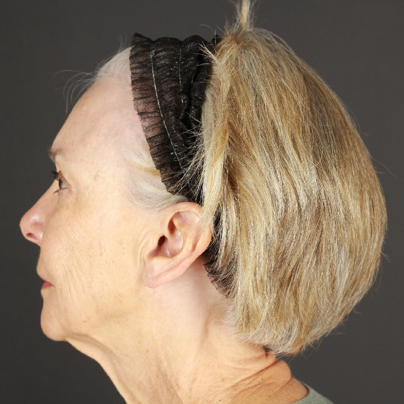 Facelift Before & After Image