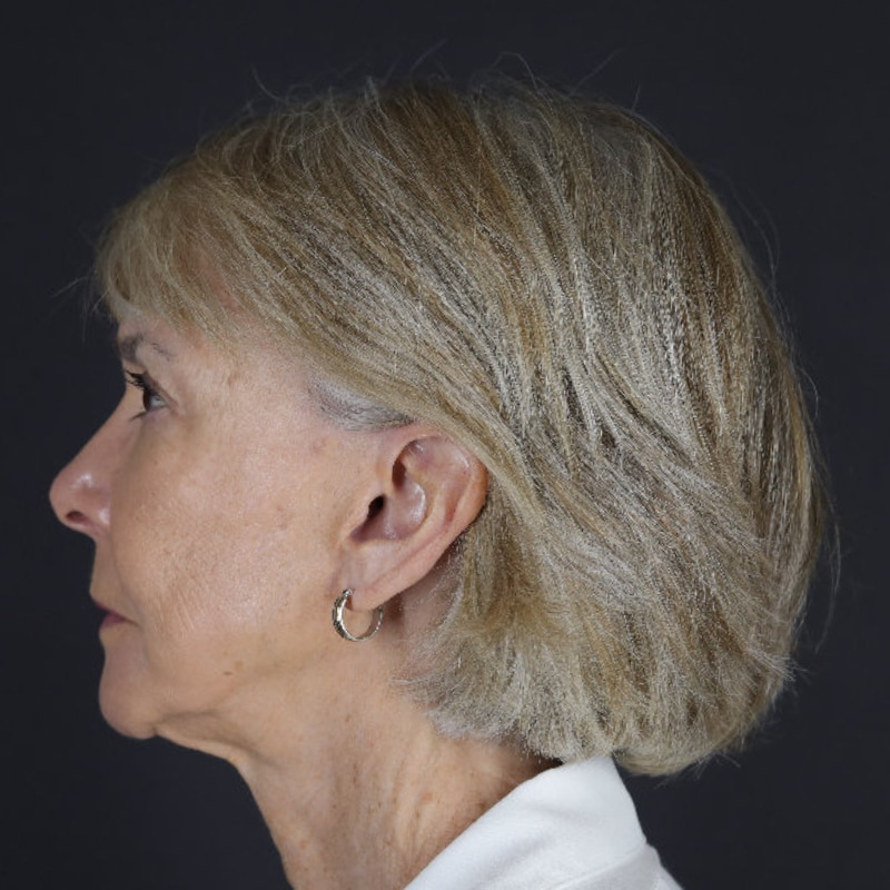 Facelift Before & After Image