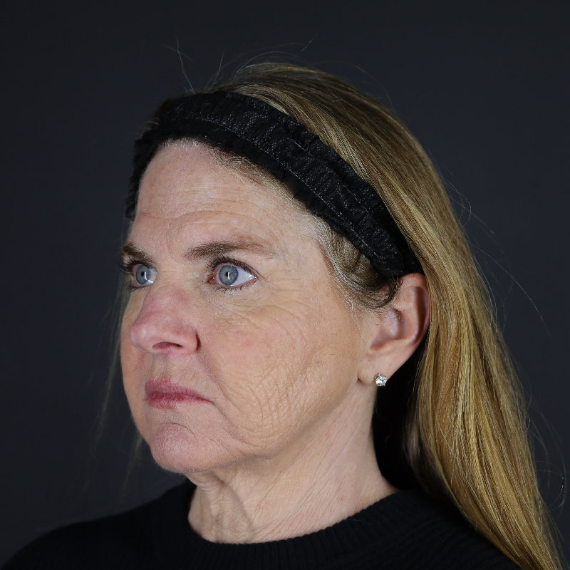 Facelift Before & After Image