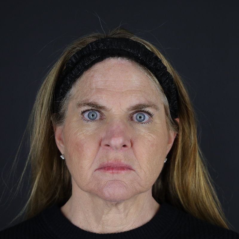 Facelift Before & After Image