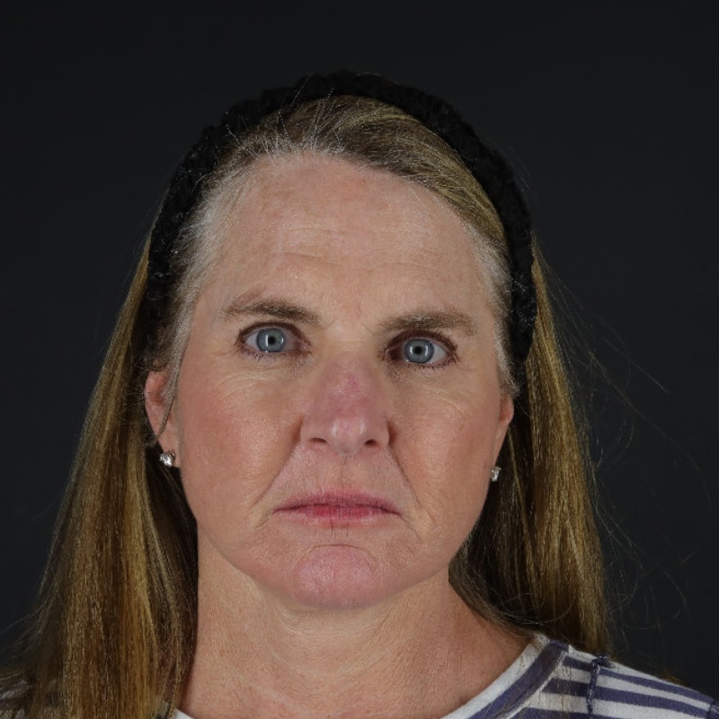 Facelift Before & After Image