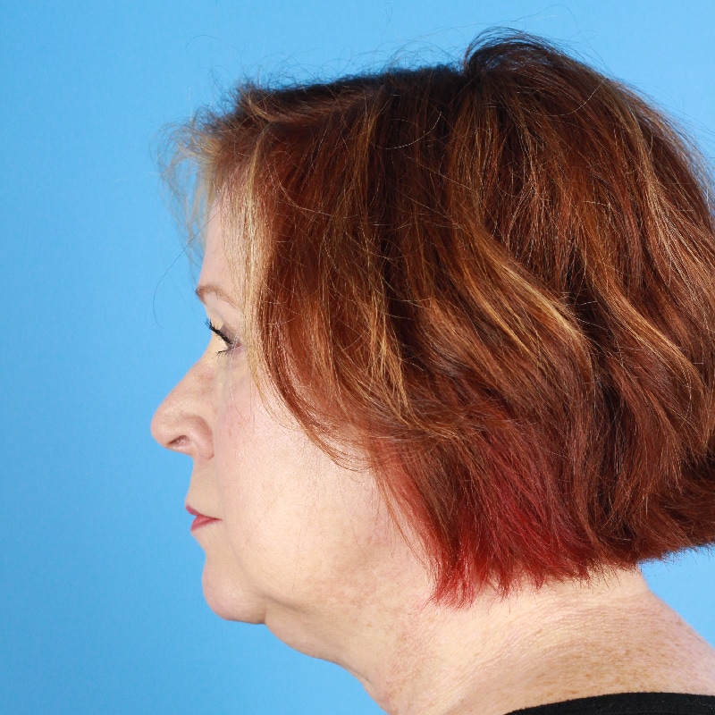 Facelift Before & After Image