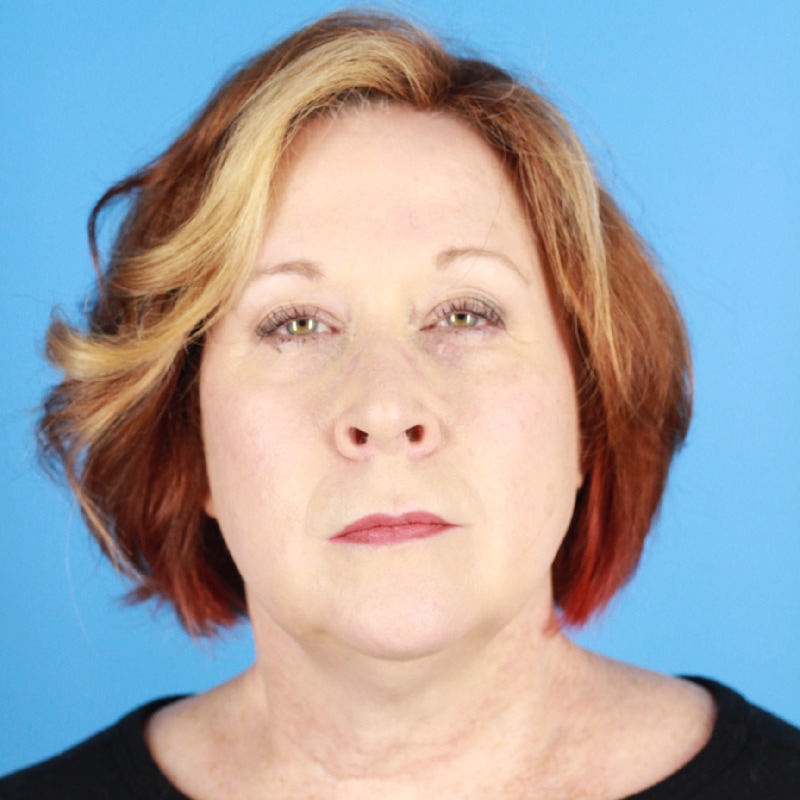 Facelift Before & After Image