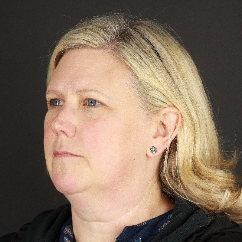 Facelift Before & After Image