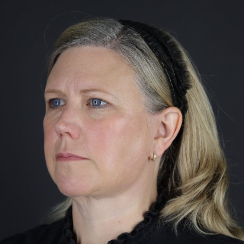 Facelift Before & After Image