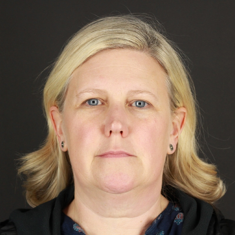 Facelift Before & After Image