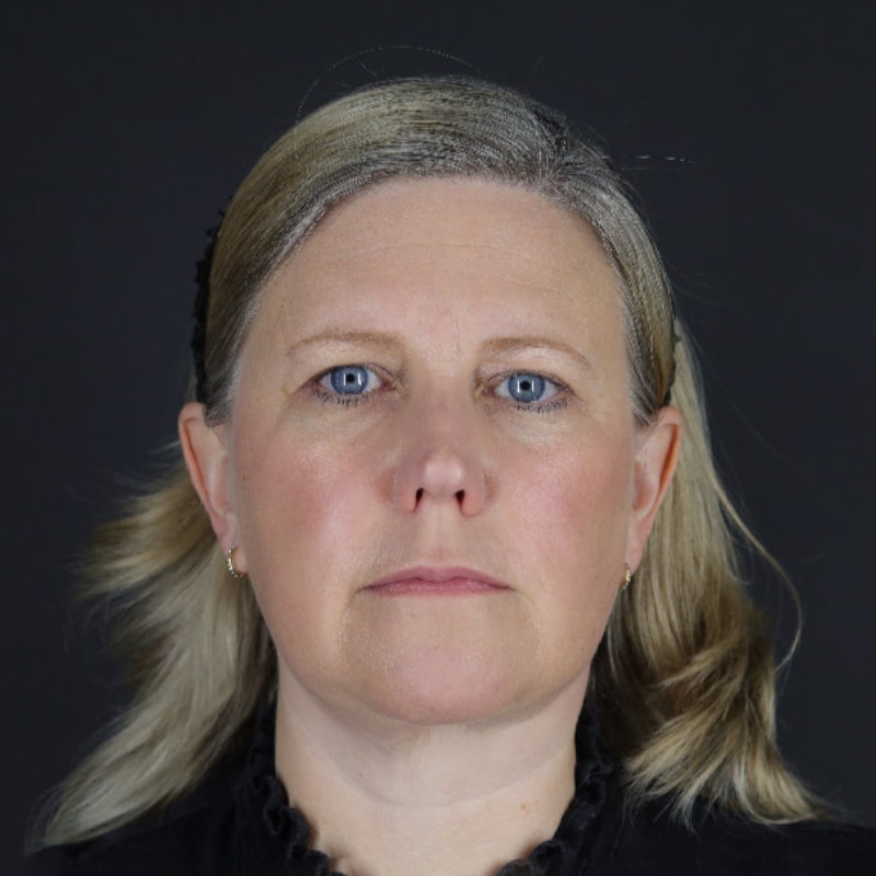 Facelift Before & After Image