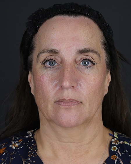 Facelift Before & After Image