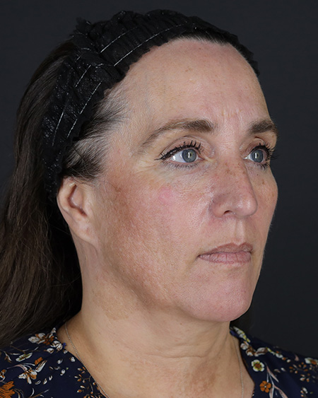 Facelift Before & After Image
